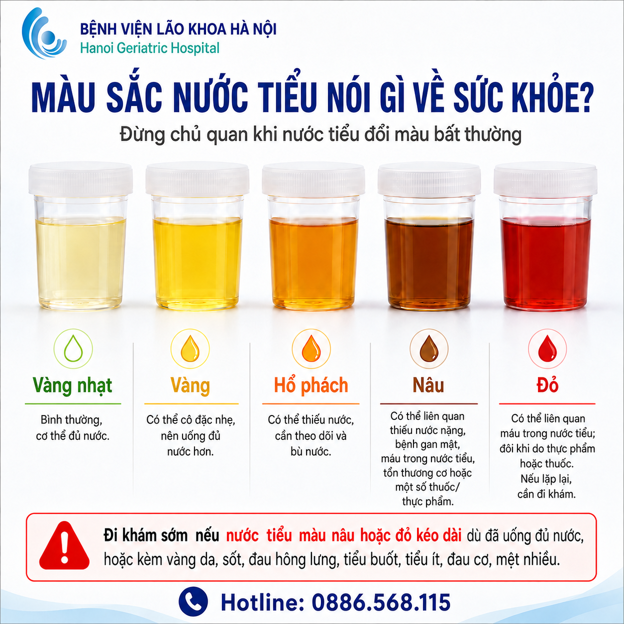 Nước tiểu màu nâu: Đừng vội nghĩ chỉ là thiếu nước